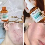 سرم ضدجوش و ضدلک سرم نیاسینامید بالانس حجم 30 میلی لیتر - Image 4
