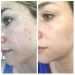 سرم لایه بردار لاکتیک اسید 10% اوردینری حجم 30 میلی لیتر - Image 4