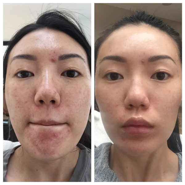 کرم ترمیم کننده سیکالفیت اون _ Avene Cicalfate Antibacterial Repairing Protective Cream - Image 14