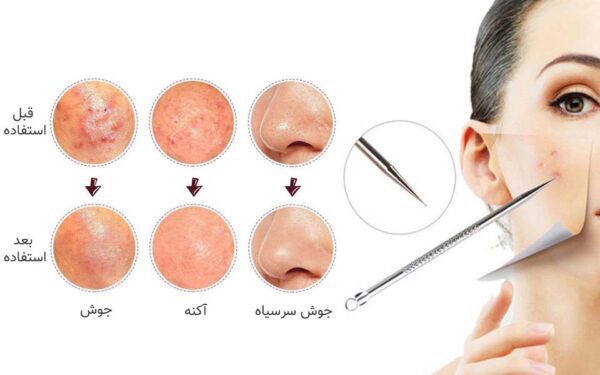 میله پیلینگ صورت - Image 1