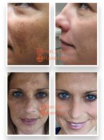 کرم ضد آفتاب ضد لک با محافظت فوق العاده بالا و SPF 50 + آکسول آرسی کازمتیک - Image 4